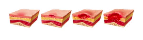 Yatak yarası evreleri